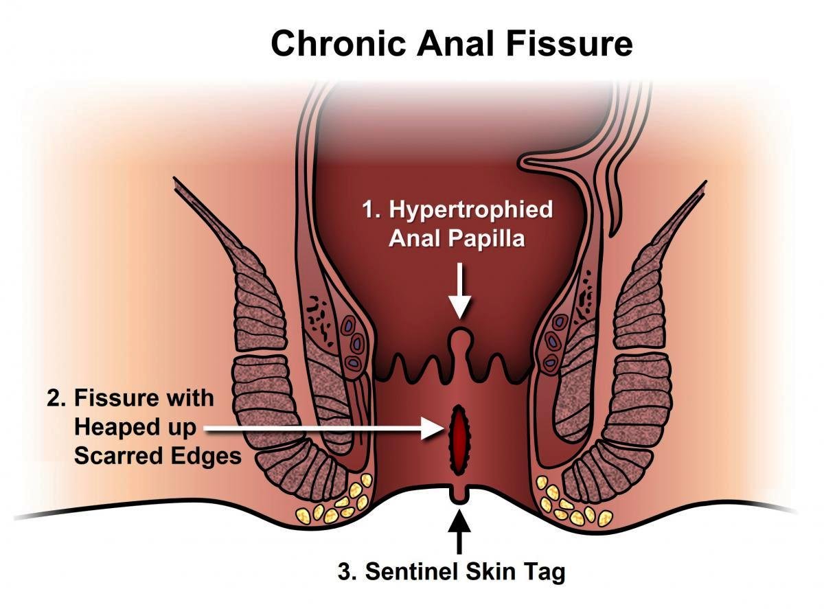 Fissure Treatment